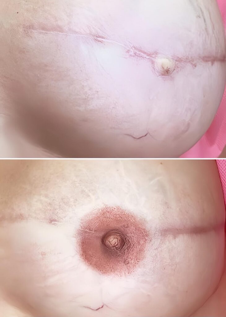 Areola Tattoo, 3D Nipple Restoration 