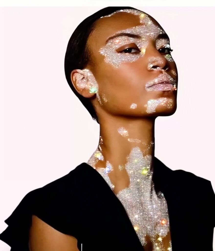 Vitiligo Camouflage Romford London at SculptPMU by Mi