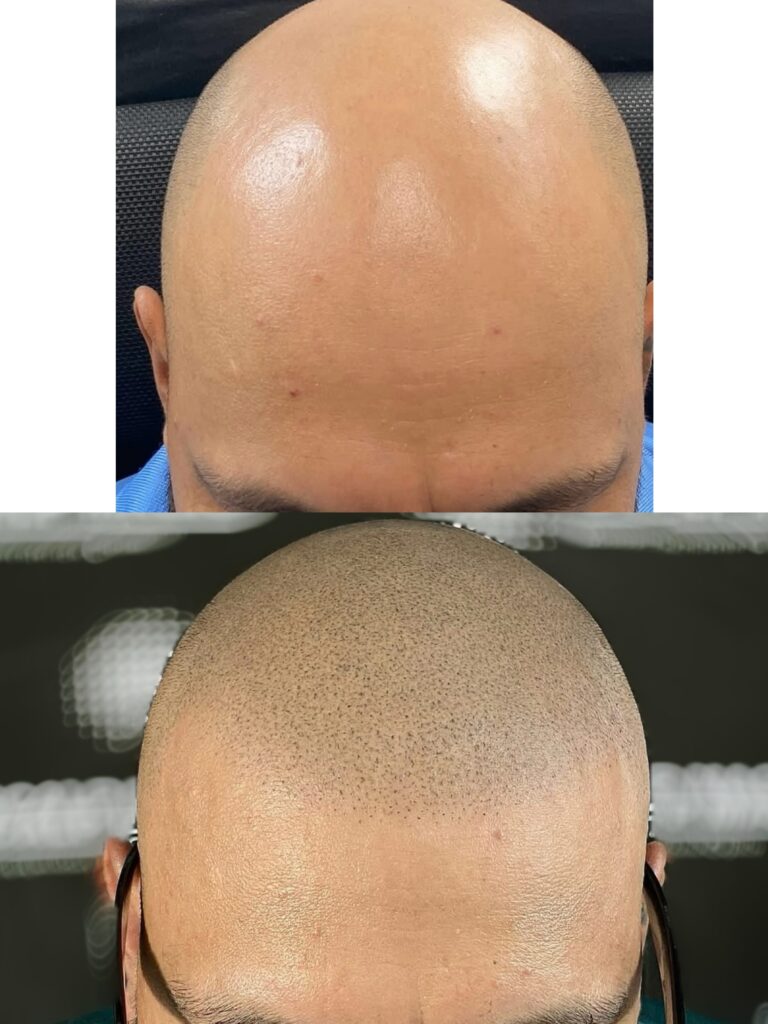 SMP before and after at SculptPMU by Mi