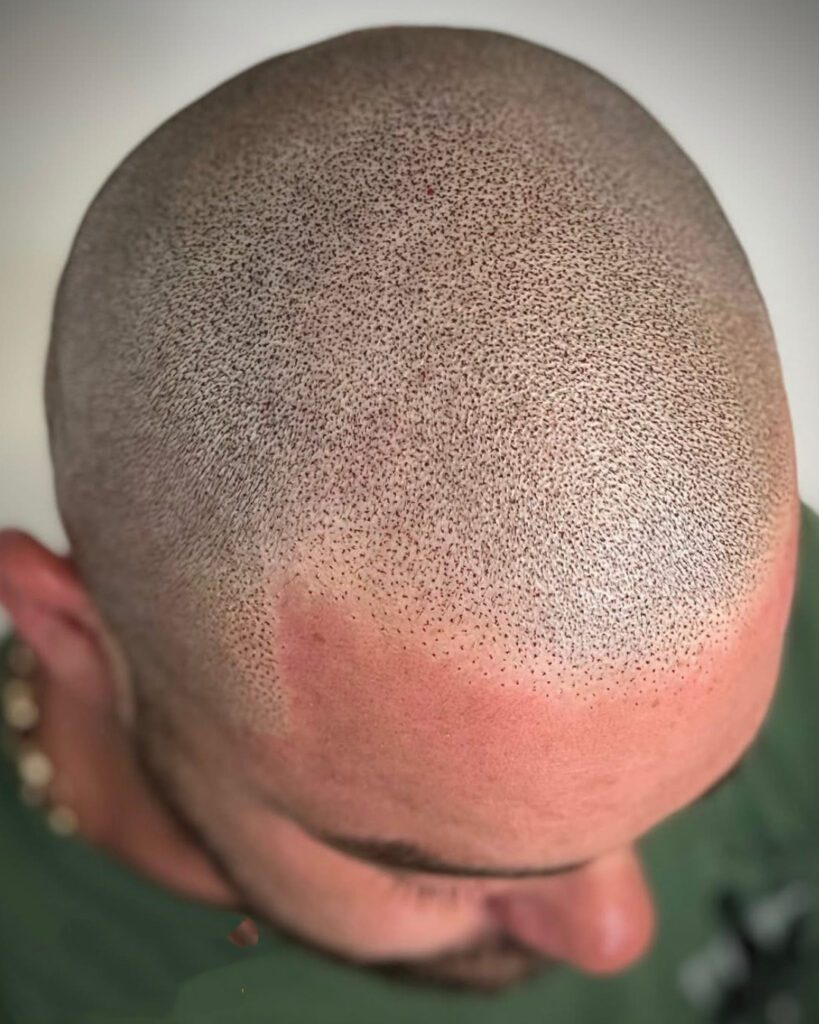 Scalp Micropigmentation/hair Restoration at SculptPMU by Mi