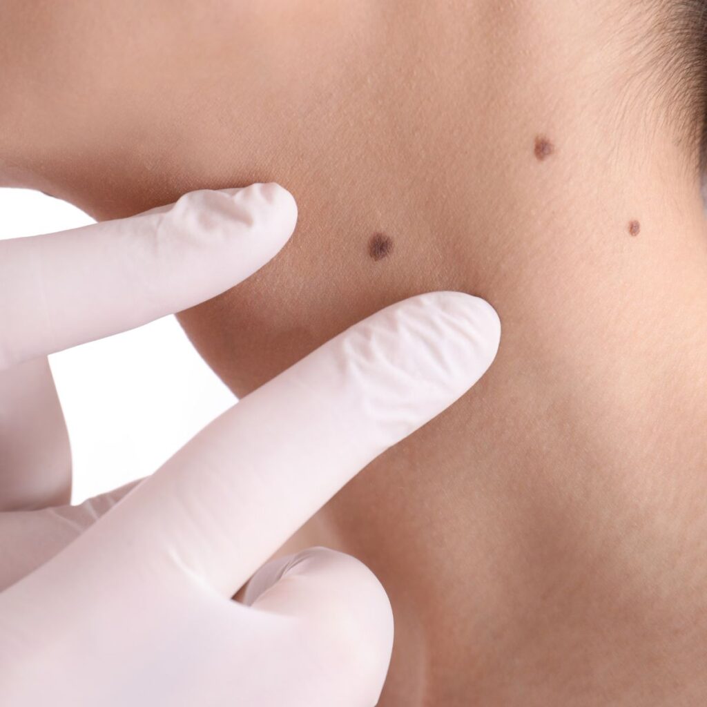 cost of skin tags and moles removal in romford