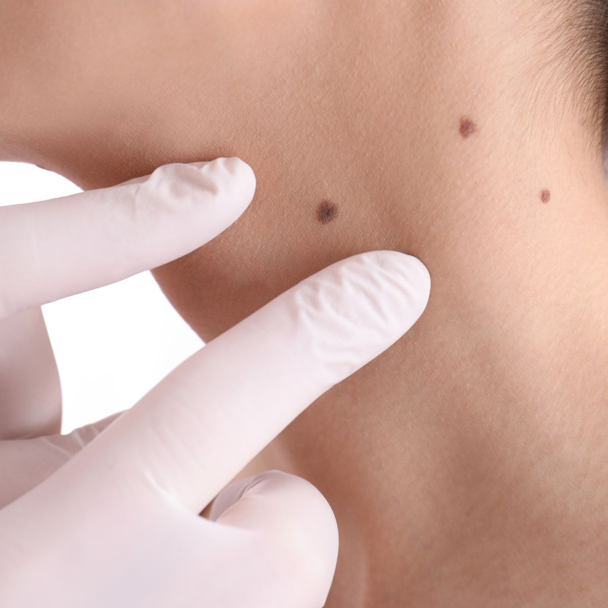 cost of skin tags and moles removal in romford