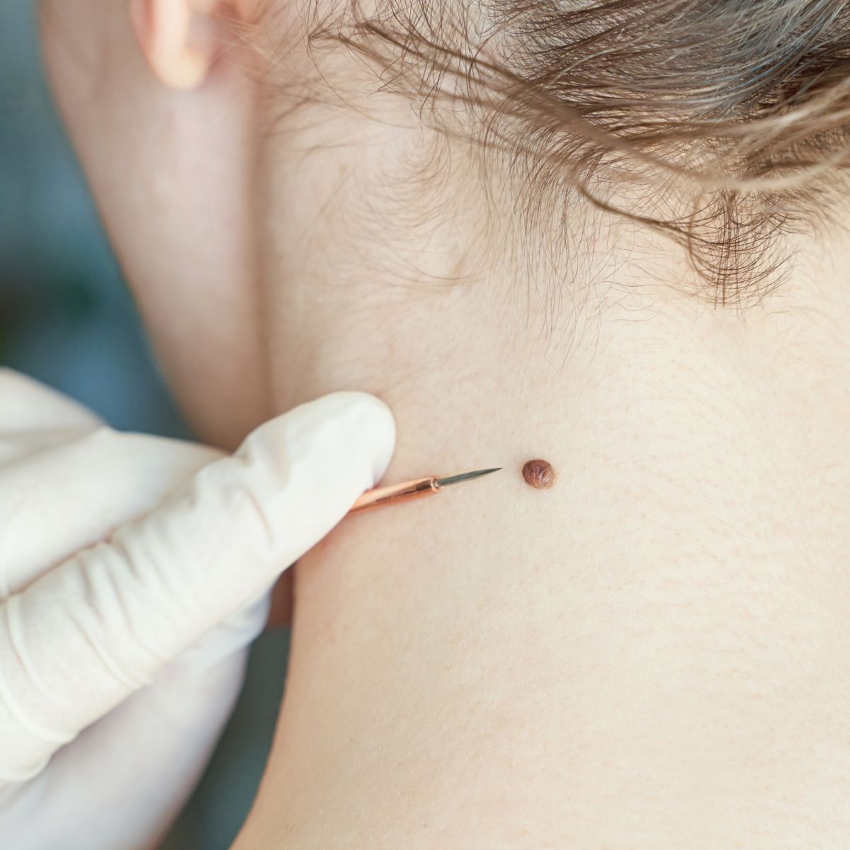 cost of skin tags and moles removal