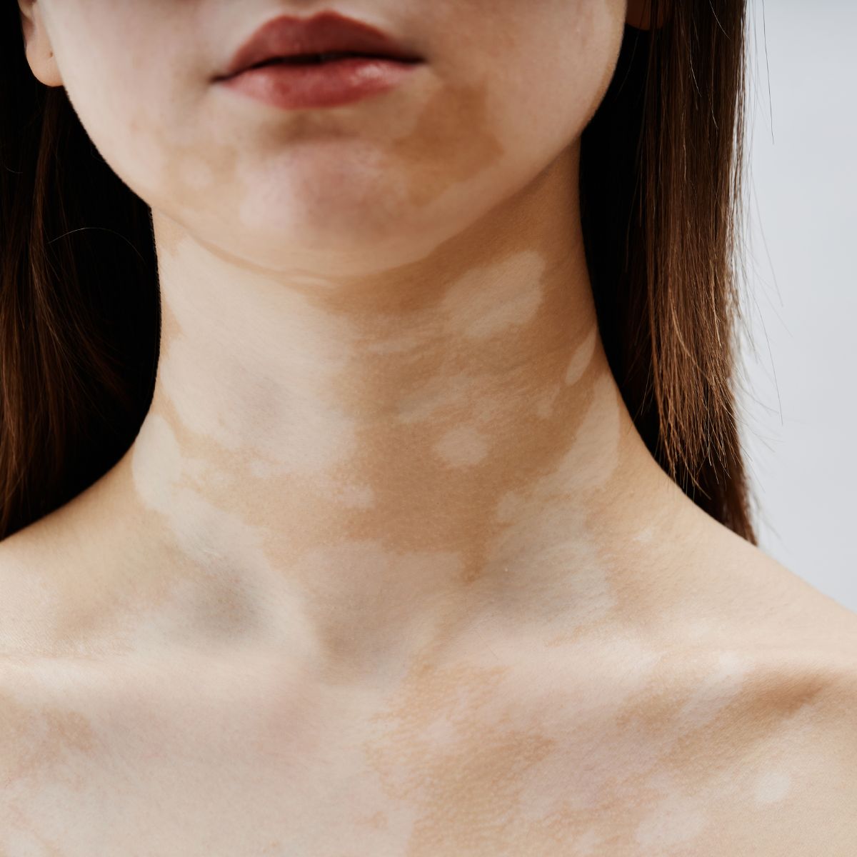 cost of vitiligo camouflage