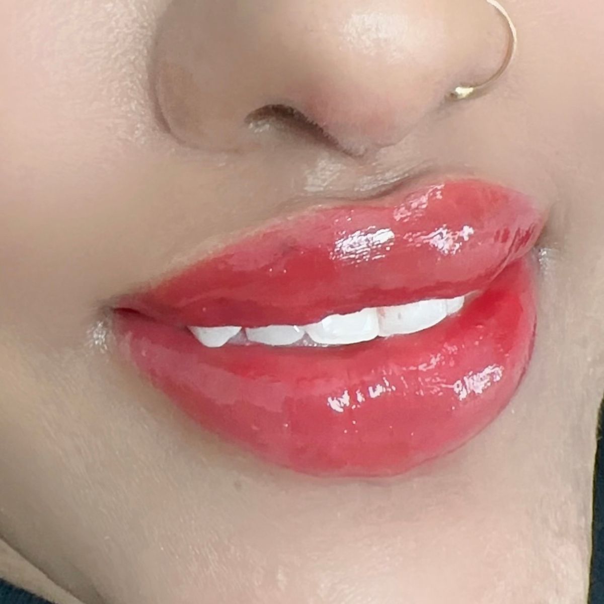 lip neutralisation cost london