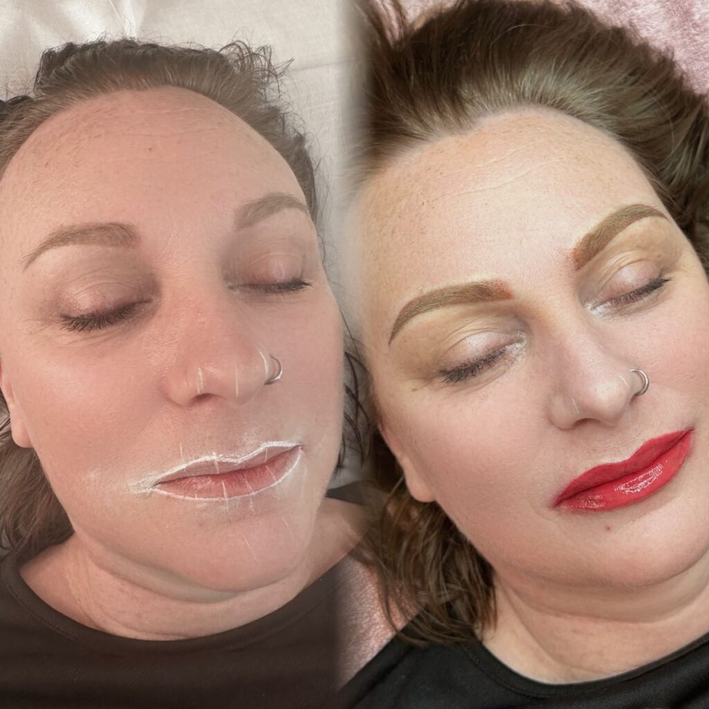 lip neutralisation cost romford