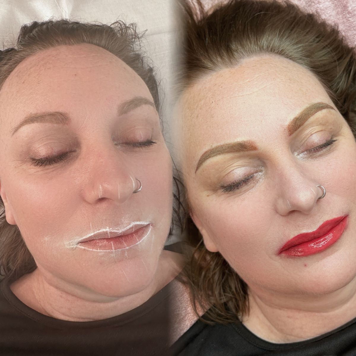 lip neutralisation cost romford
