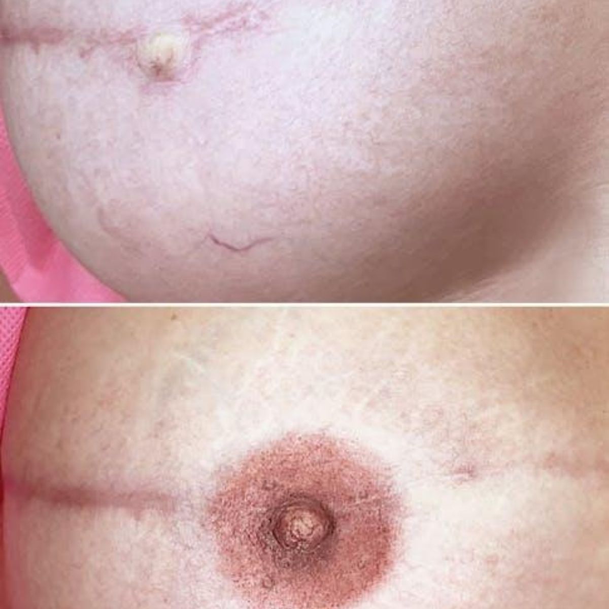 procedure areola restoration
