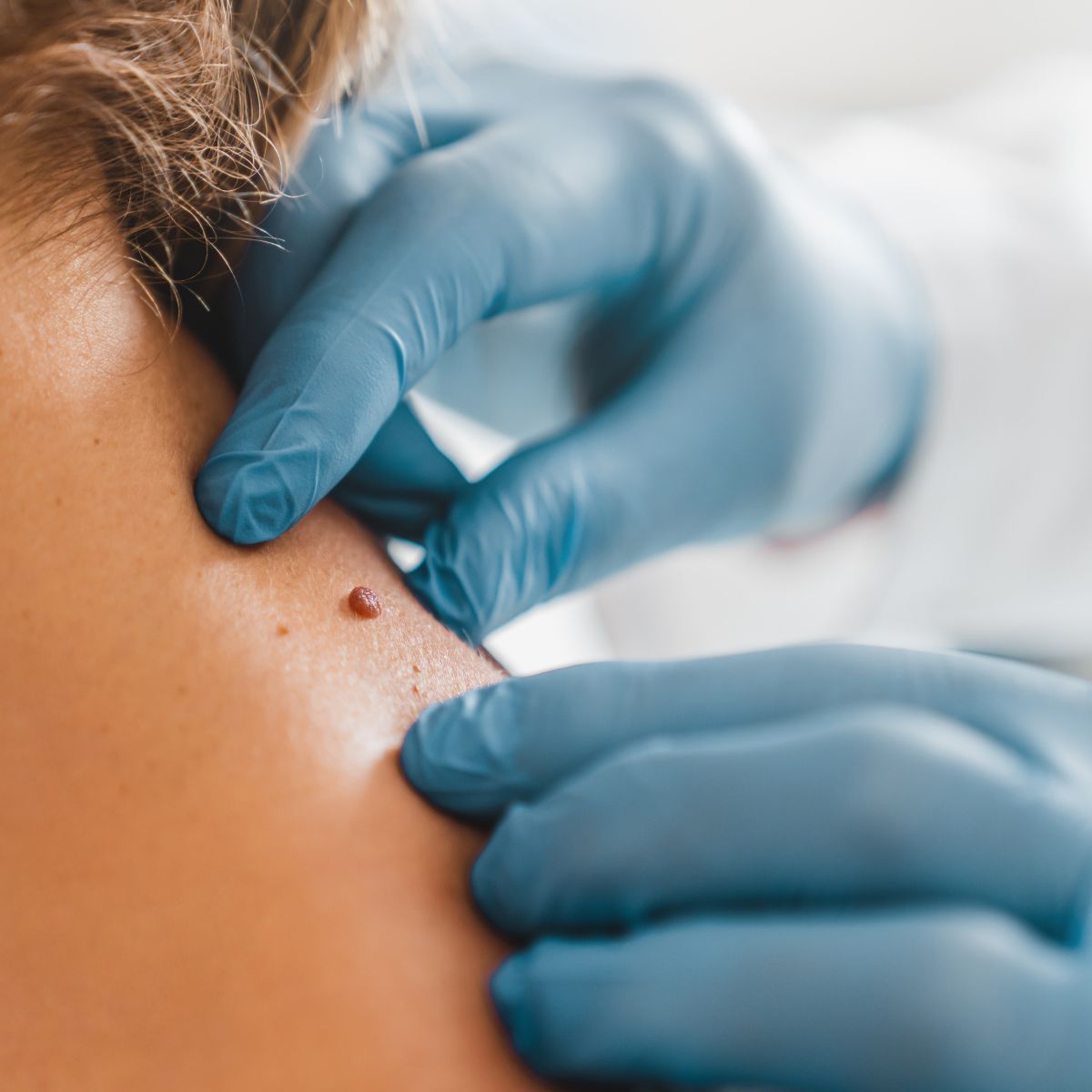 procedure of skin tags and moles removal