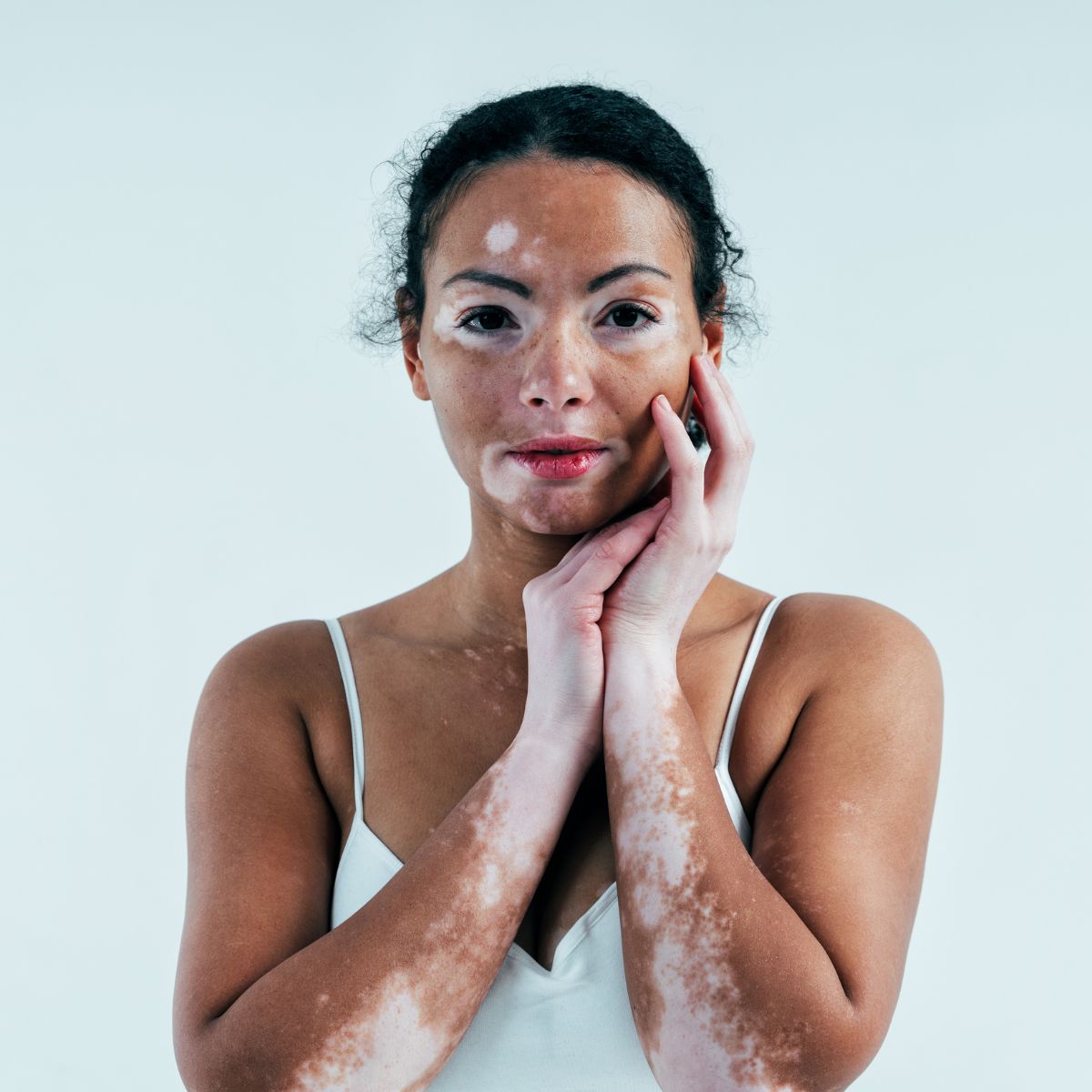 procedure of vitiligo camouflage