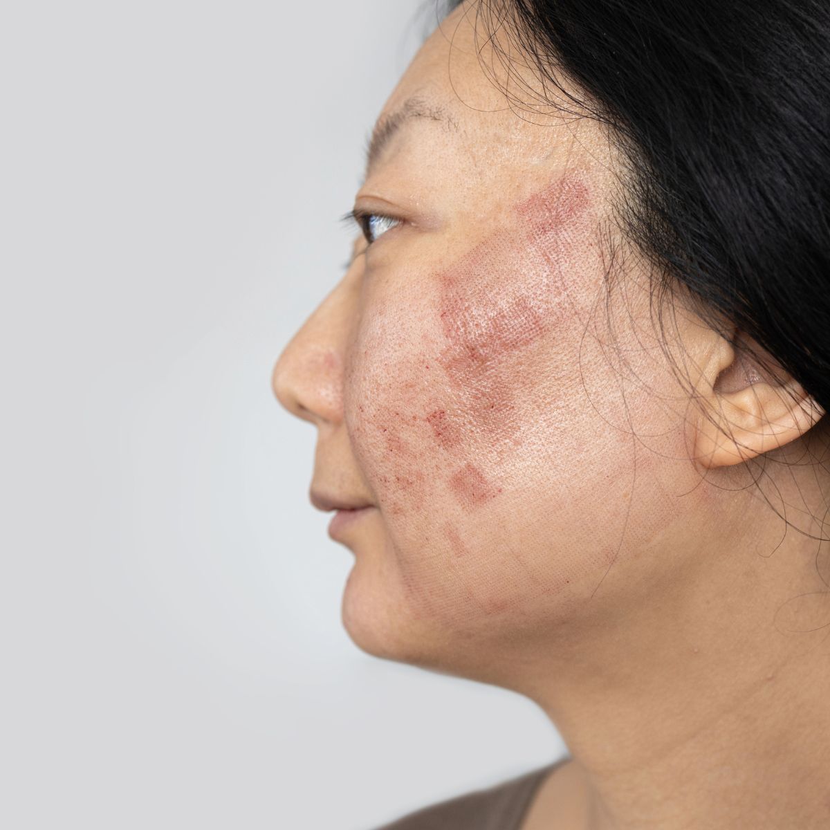 scar camouflage cost in london