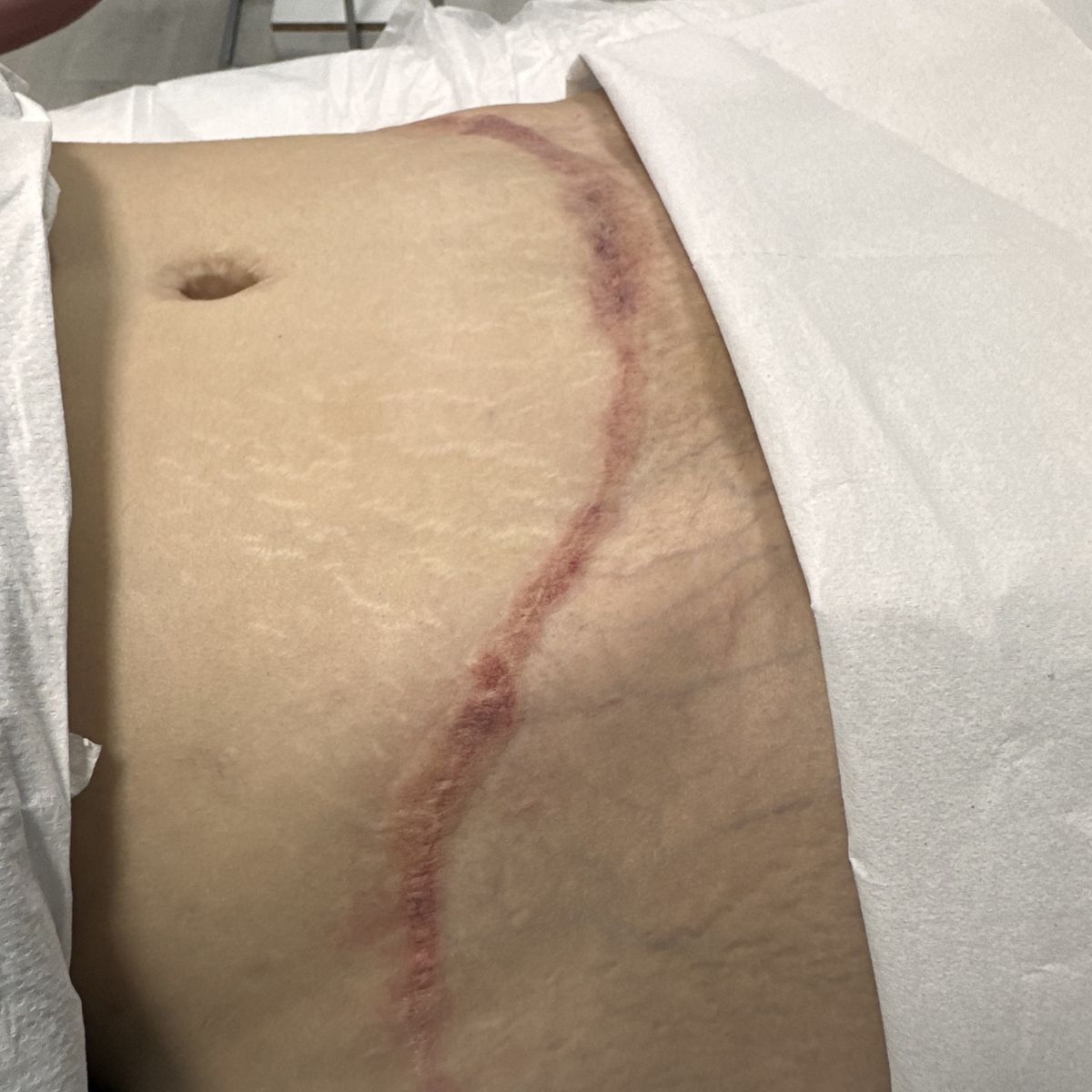 stretch mark camouflage