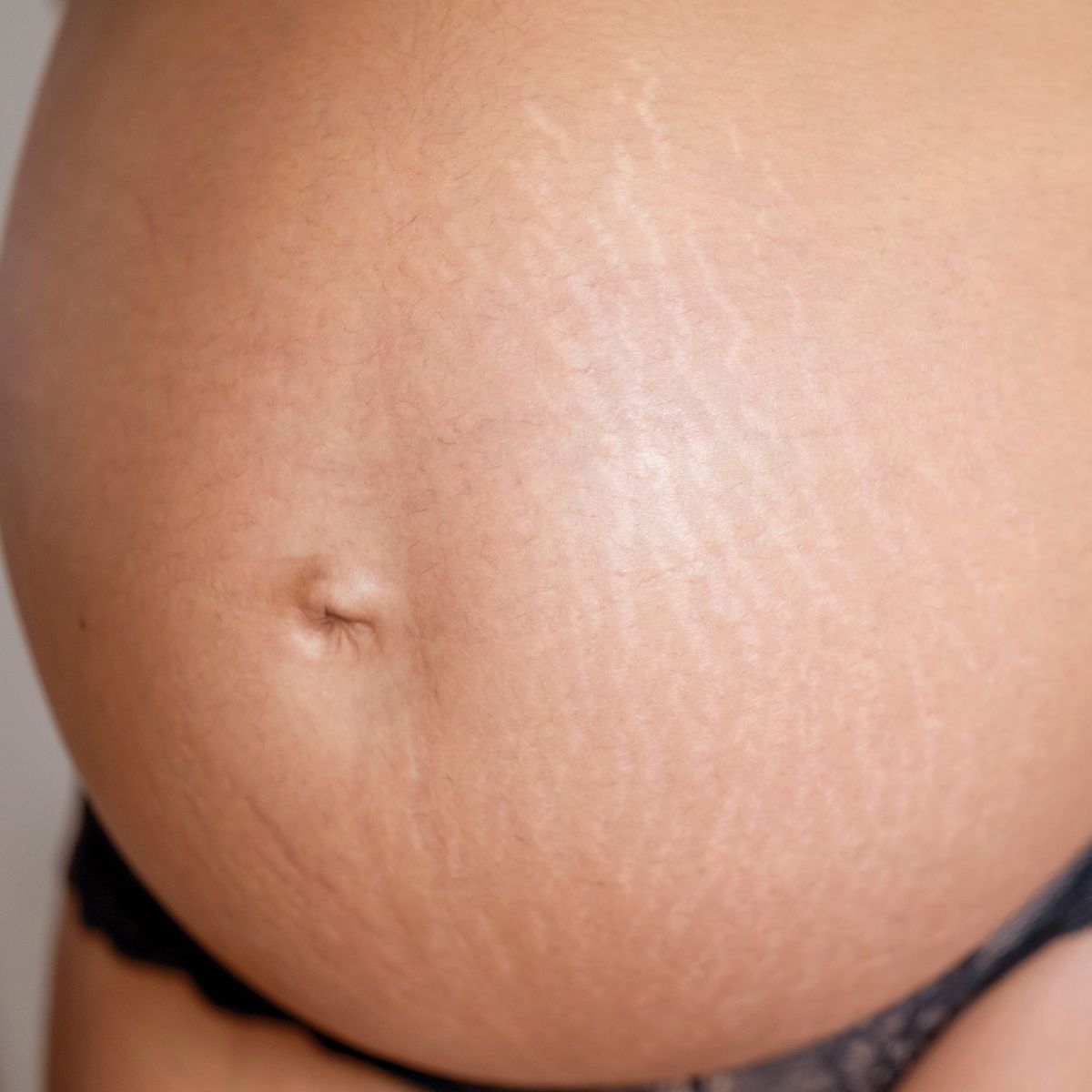 stretch mark restoration cost in london