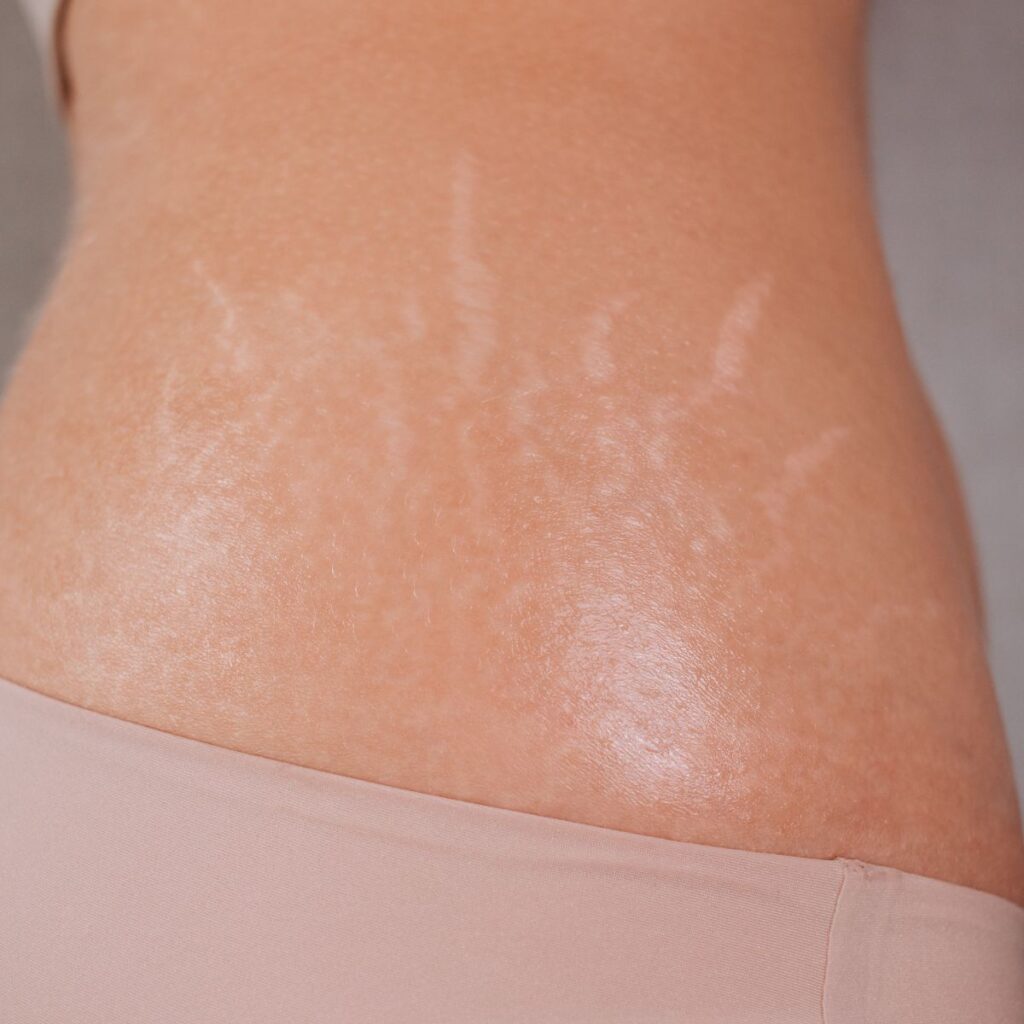 what causes stretch marks