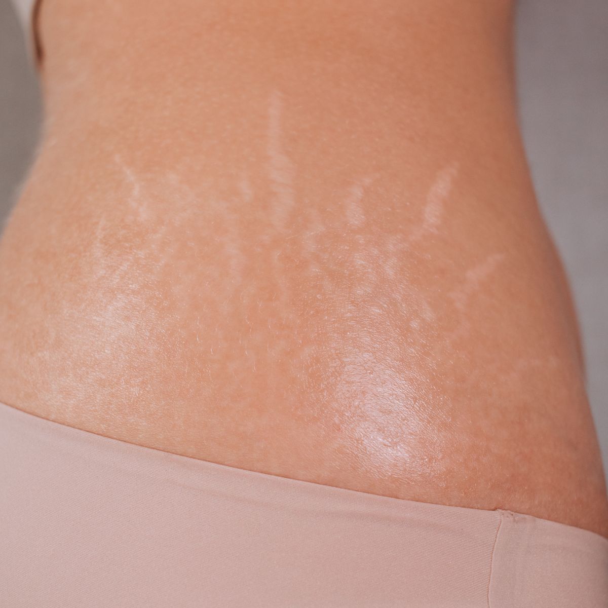 what causes stretch marks