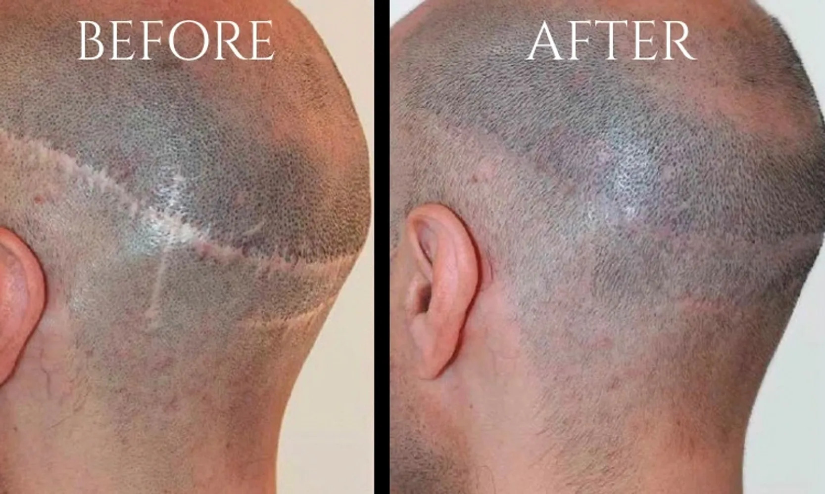 Before-and-after scalp micropigmentation treatment showing hair transplant scar camouflage and improved scalp coverage